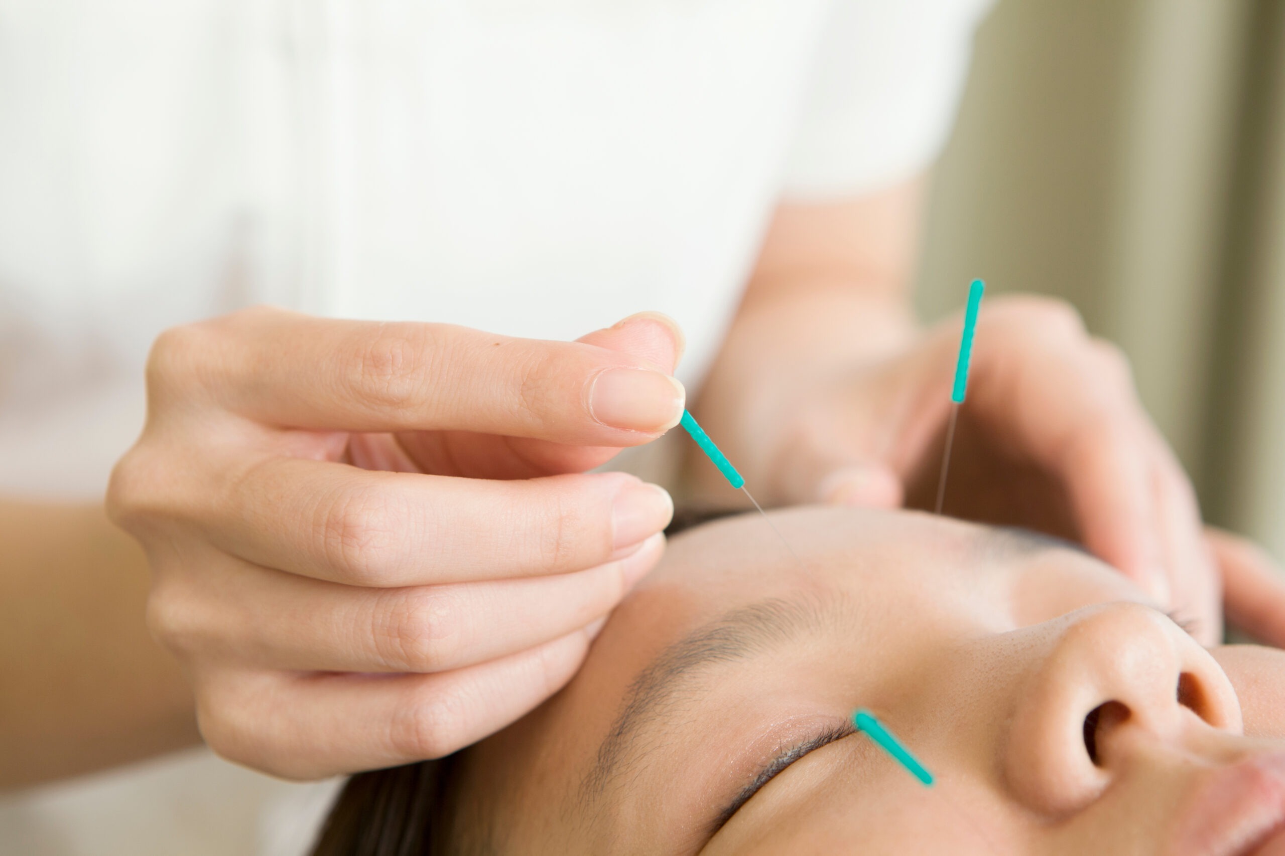 Facial acupuncture scaled